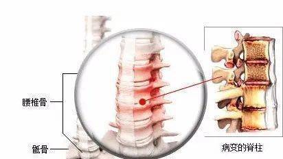 早期的强直性脊柱炎都有哪些症状呢？怎么治疗？