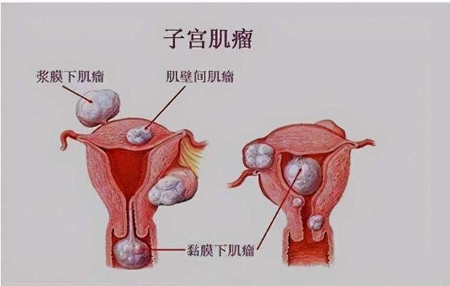 女性为什么会得子宫肌瘤