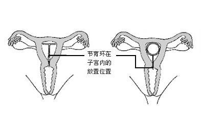 怀孕左腰部隐痛的原因_女性腰部隐痛_左腰部腹部隐痛的原因
