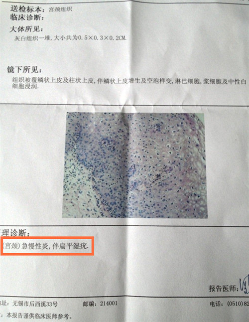 北京万国医院治疗女性尖锐湿疣初期症状；初期的症状