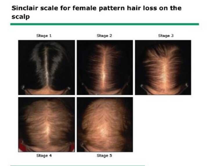 女性脱发的症状都有哪些?(1)_
